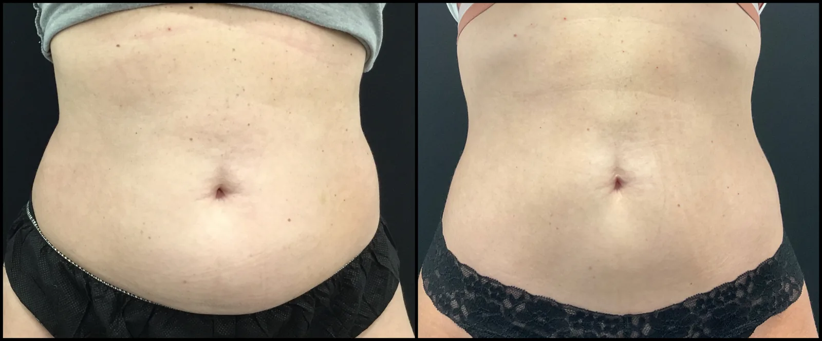 Avant et après CoolSculpting — abdomen plus plat après cryolipolyse.
