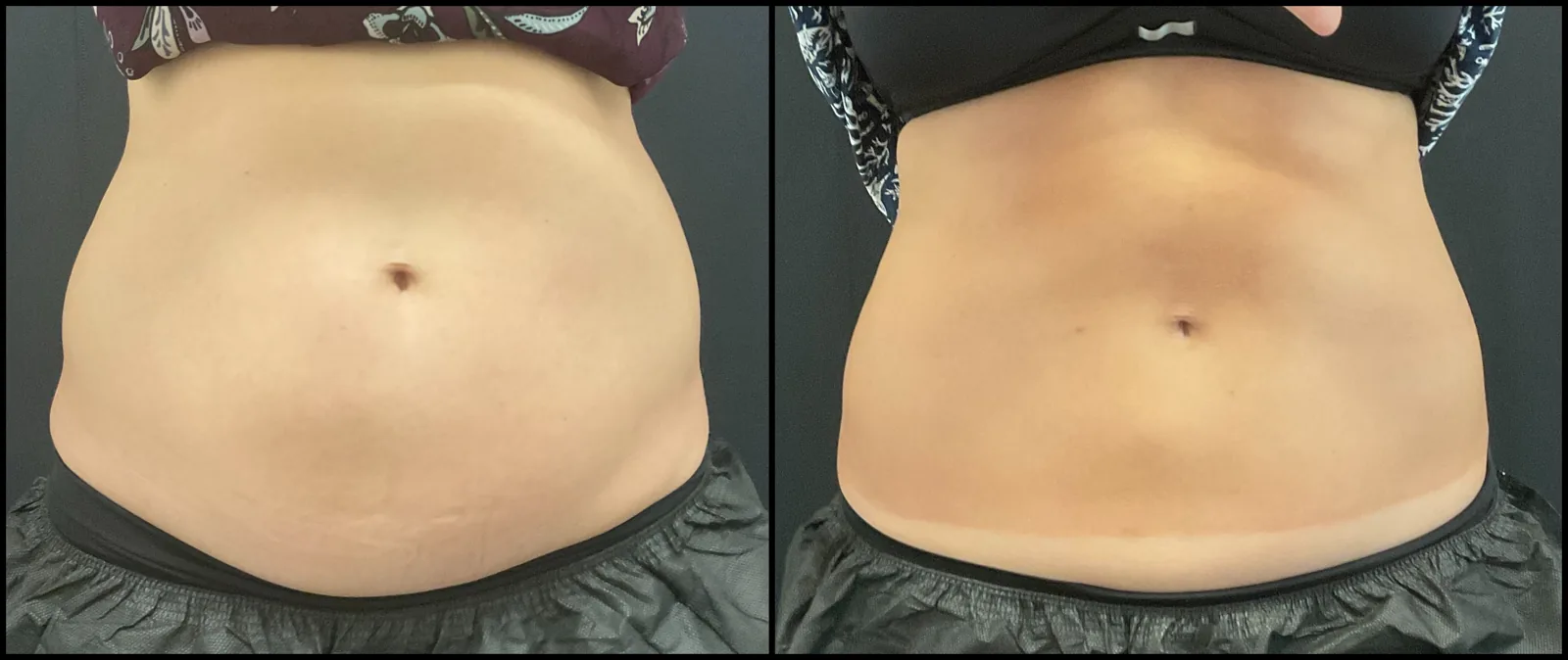Avant et après CoolSculpting — taille et hanches redessinées.