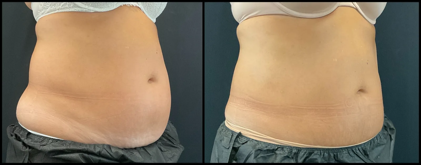 Avant et après CoolSculpting — abdomen visiblement aplani, vue oblique.