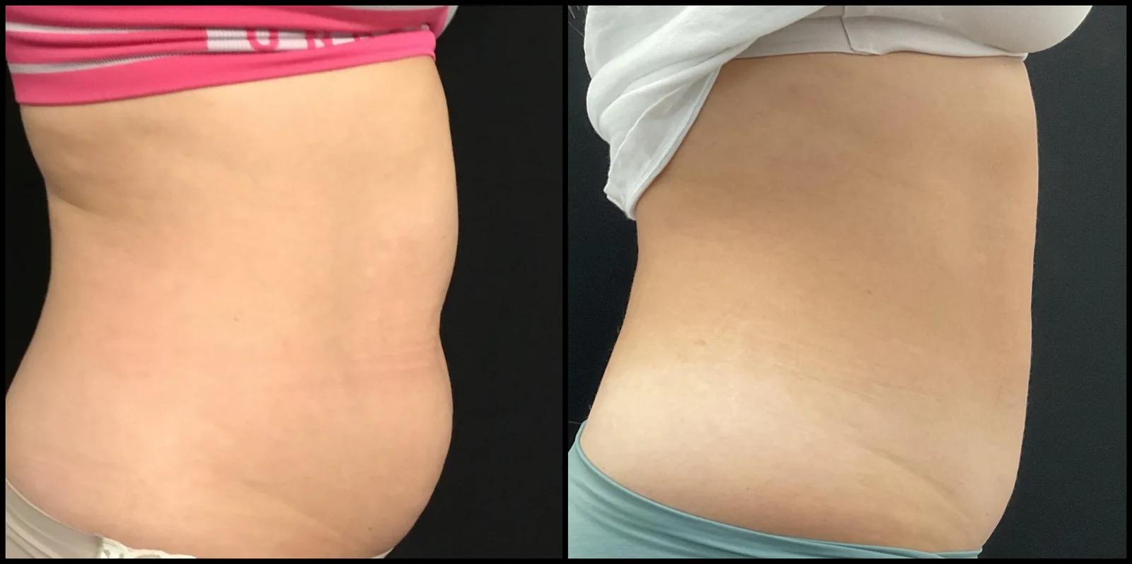 Avant et après CoolSculpting — projection abdominale réduite, vue de profil.
