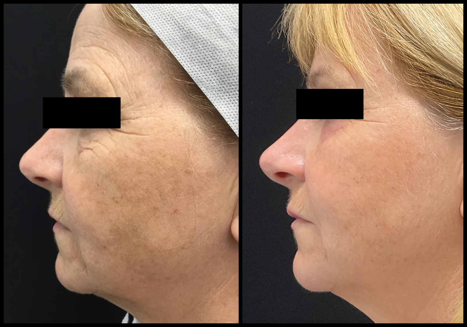 Avant et après Morpheus8 — joue raffermie et texture lissée, vue de profil.