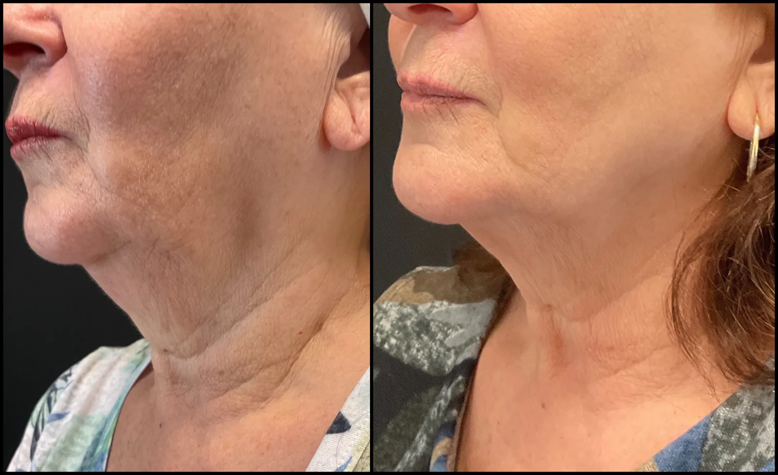 Avant et après Morpheus8 — bas du visage et cou raffermis, vue oblique, ligne mandibulaire mieux définie.