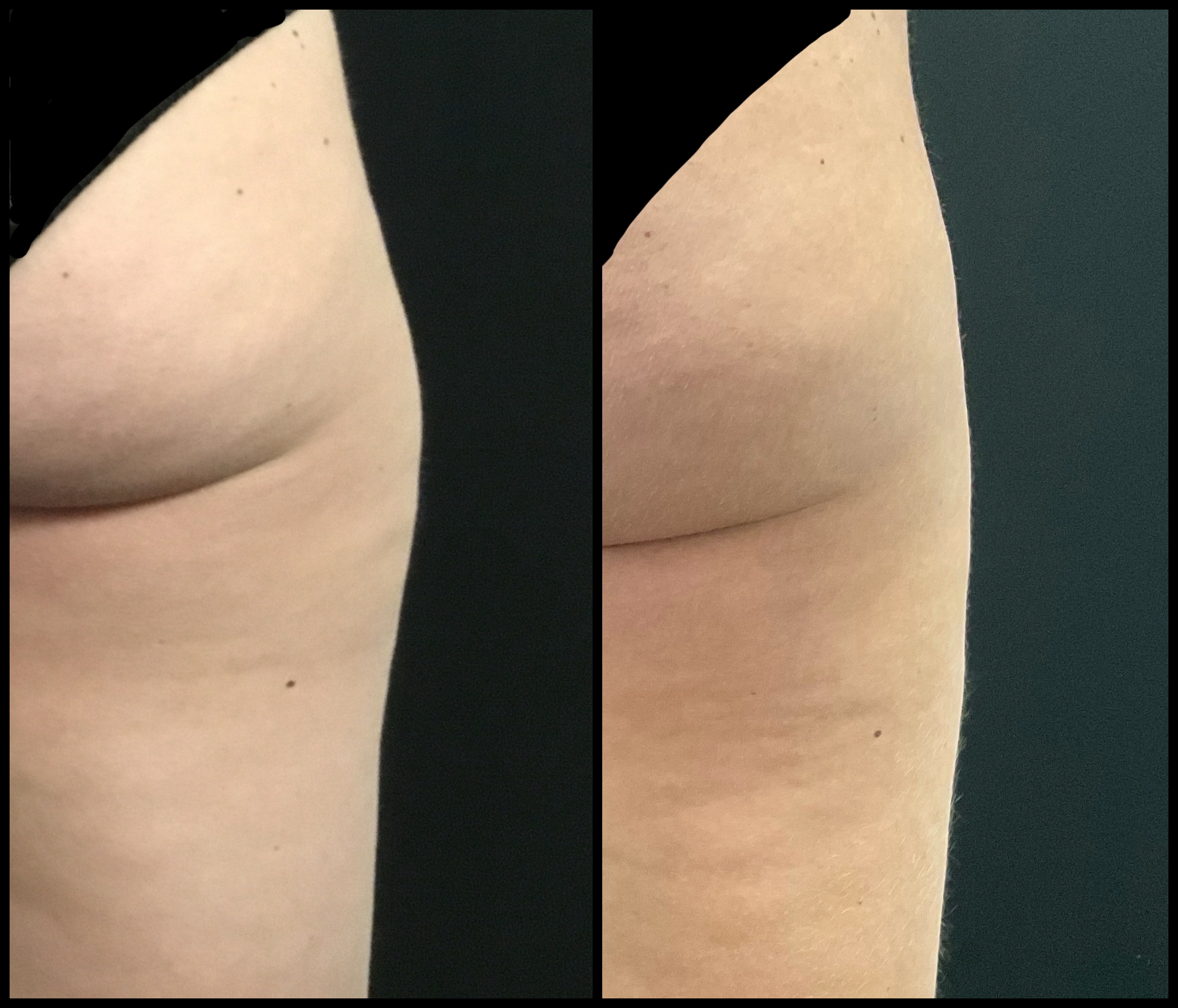 Avant/Après CoolSculpting - Patiente A.