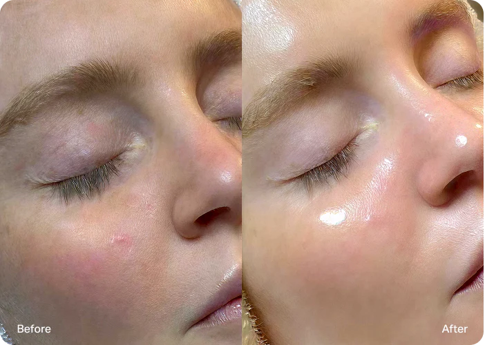 Avant et après Hydrafacial