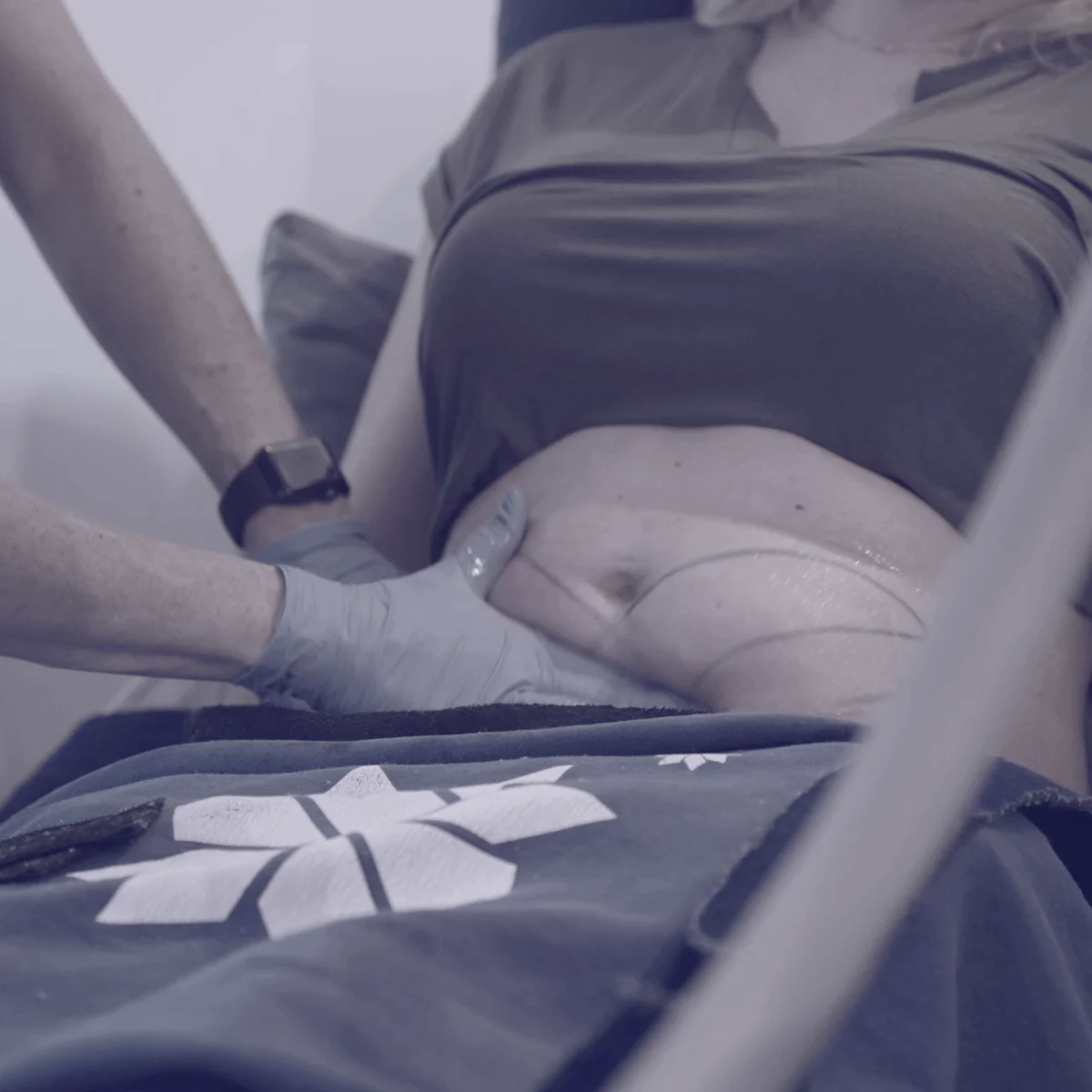 Évaluation de la zone à traiter lors d'une vraie séance CoolSculpting chez O'Derma