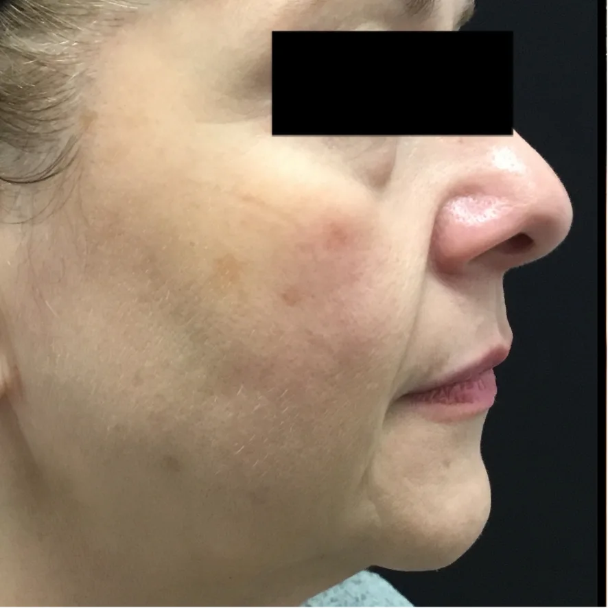 Avant traitement Morpheus8 — Clinique O'Derma