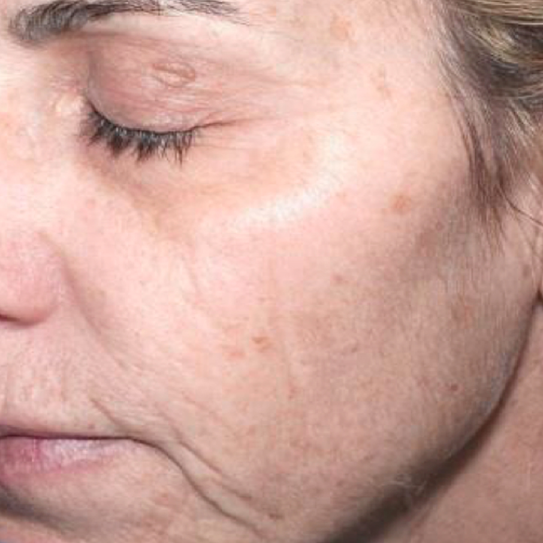 Taches & Pigmentation