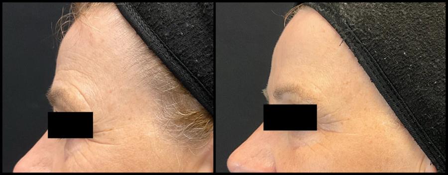 Avant et après laser CO2 — texture du visage lissée et rides adoucies. — Profil gauche