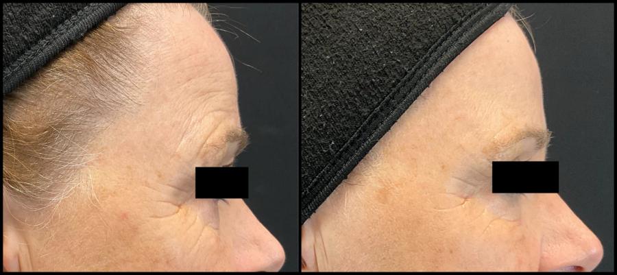 Avant et après laser CO2 — texture du visage lissée et rides adoucies. — Profil droit