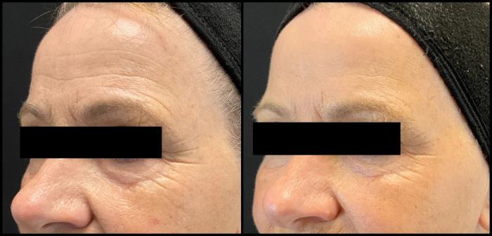 Avant et après laser CO2 — texture du visage lissée et rides adoucies.