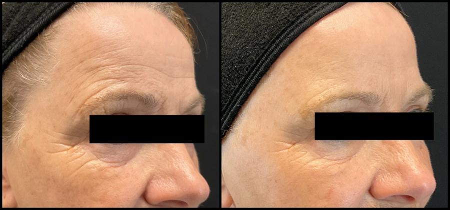 Avant et après laser CO2 — texture du visage lissée et rides adoucies. — Oblique droite