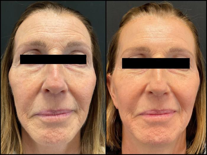 Avant et après laser CO2 — visage lissé, grain de peau affiné et teint plus uniforme.