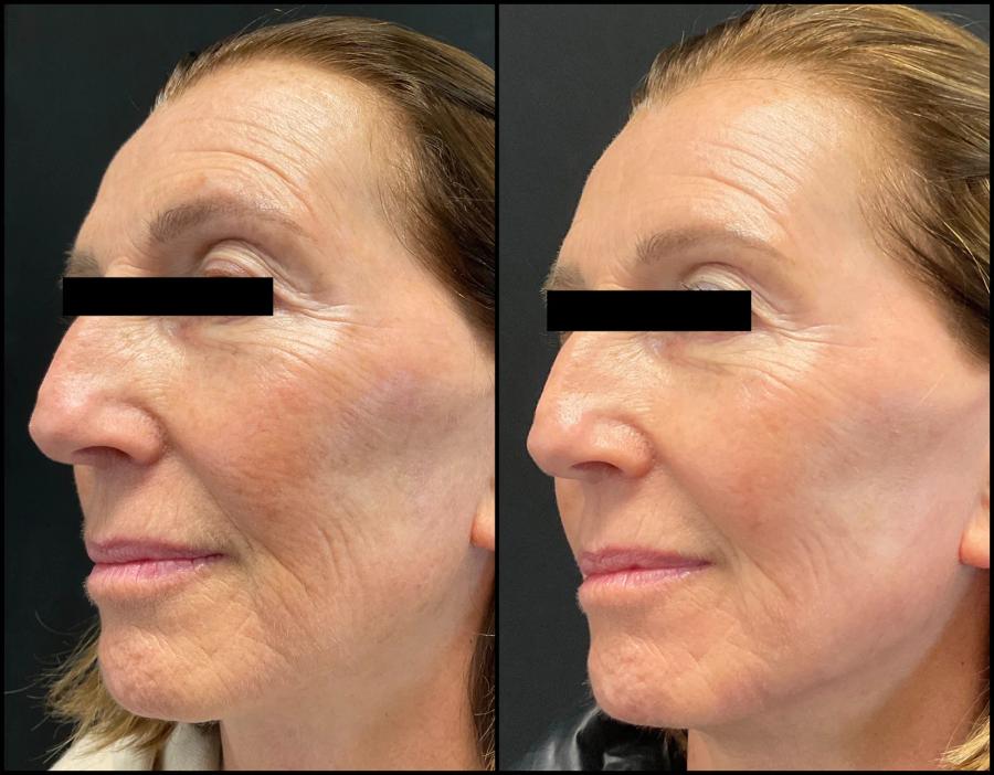Avant et après laser CO2 — visage lissé, grain de peau affiné et teint plus uniforme. — Profil