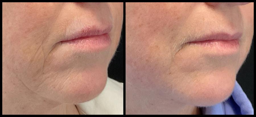 Avant et après laser CO2 — rides péribuccales adoucies, contour de la bouche lissé.