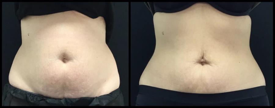 Avant et après CoolSculpting — abdomen aminci et taille redessinée, vue de face.