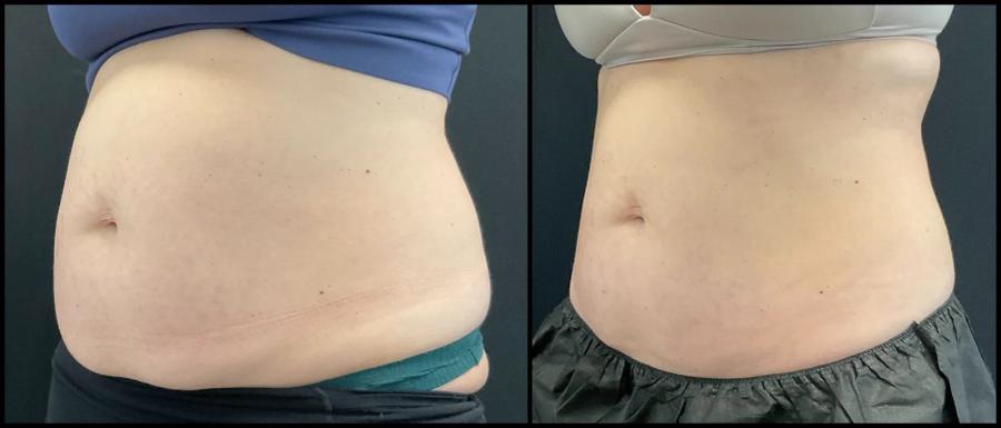 Avant et après CoolSculpting — abdomen aplani, vue oblique.