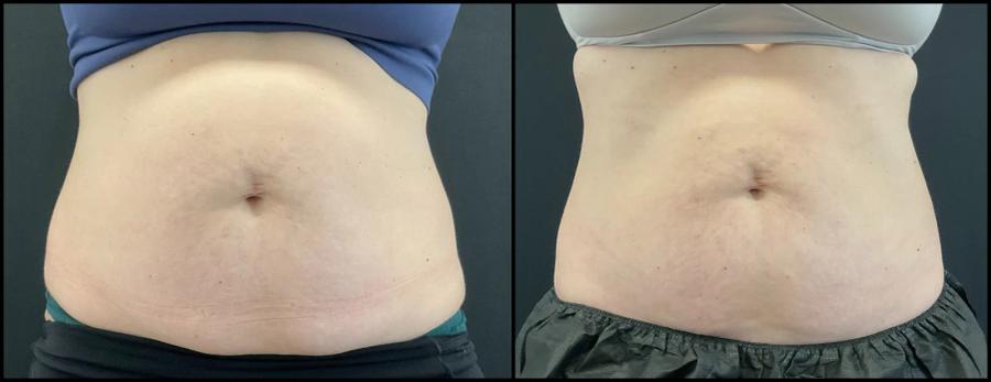 Avant et après CoolSculpting — taille affinée et abdomen aplani.
