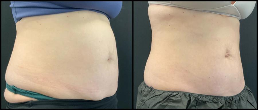 Avant et après CoolSculpting — taille affinée et abdomen aplani. — Oblique droite