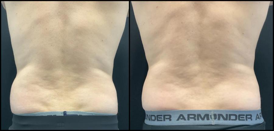 Avant et après CoolSculpting — contour abdominal redessiné. — Vue arrière