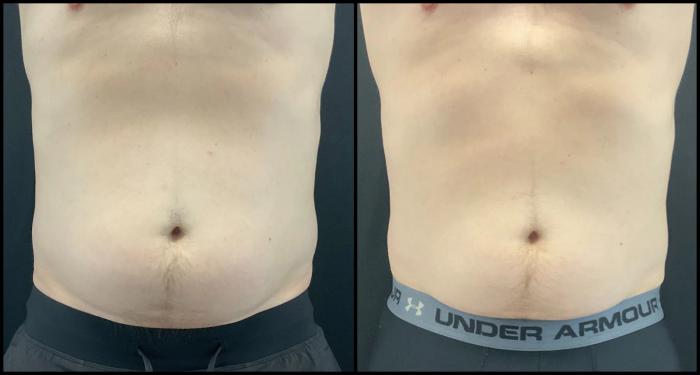 Avant et après CoolSculpting — contour abdominal redessiné.