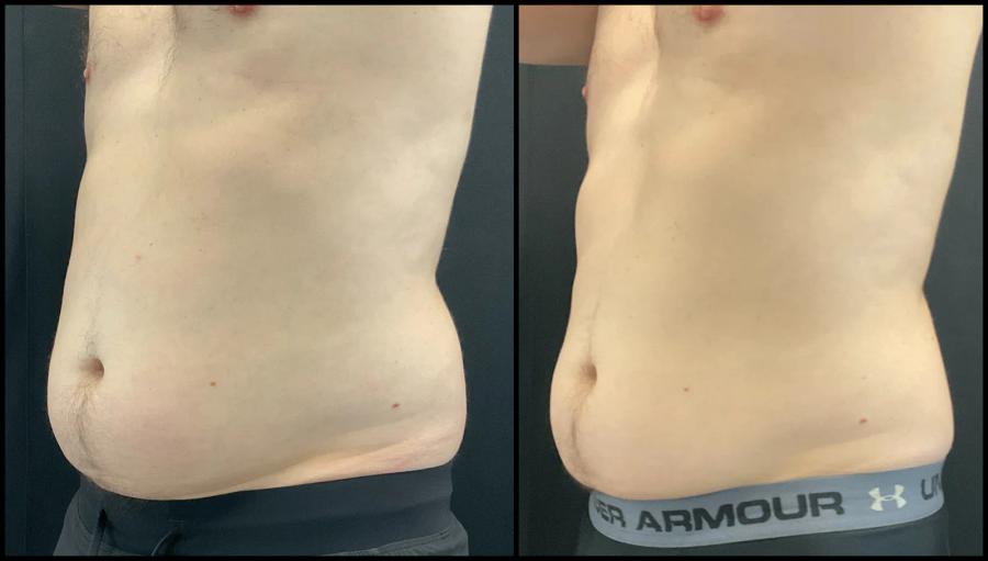 Avant et après CoolSculpting — contour abdominal redessiné. — Oblique gauche