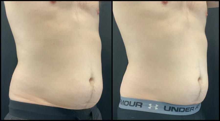 Avant et après CoolSculpting — contour abdominal redessiné. — Oblique droite