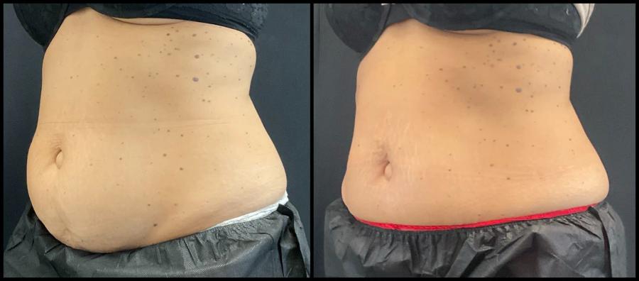 Avant et après CoolSculpting — volume abdominal nettement réduit, vue oblique. — Oblique gauche
