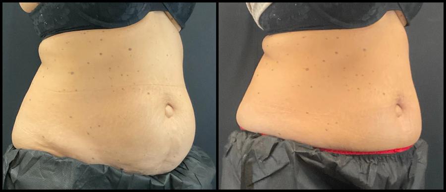 Avant et après CoolSculpting — volume abdominal nettement réduit, vue oblique.