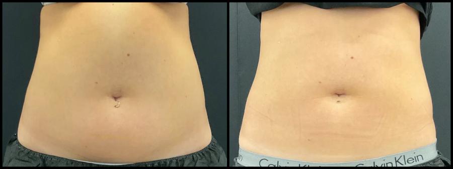 Avant et après CoolSculpting — silhouette de face plus tonique.