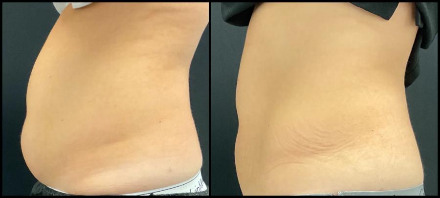 Avant et après CoolSculpting — silhouette de face plus tonique. — Profil gauche