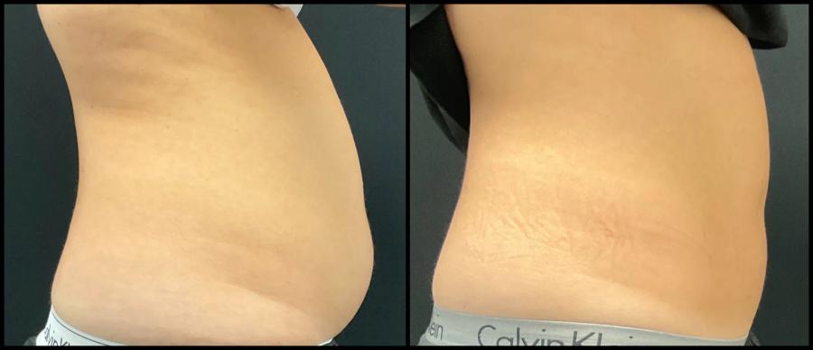 Avant et après CoolSculpting — silhouette de face plus tonique. — Profil droit