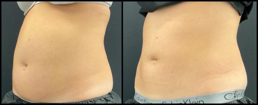 Avant et après CoolSculpting — silhouette de face plus tonique. — Oblique gauche