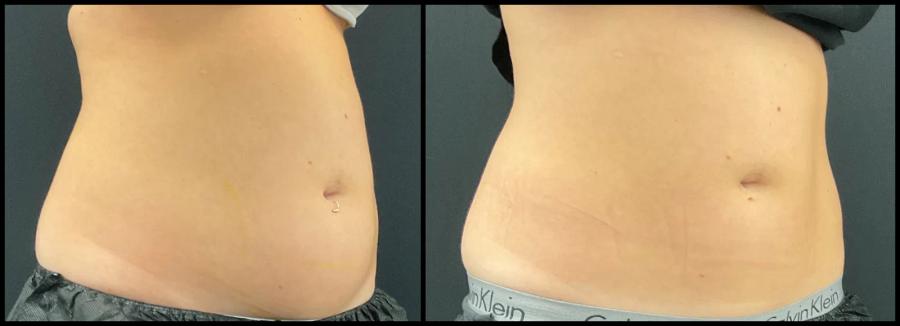 Avant et après CoolSculpting — silhouette de face plus tonique. — Oblique droite