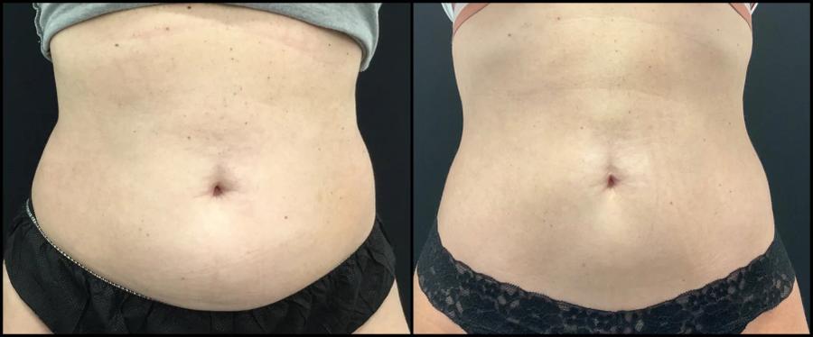 Avant et après CoolSculpting — abdomen plus plat après cryolipolyse.