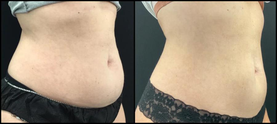 Avant et après CoolSculpting — abdomen plus plat après cryolipolyse. — Vue oblique