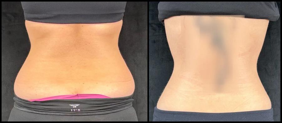 Avant et après CoolSculpting — réduction de la graisse de la taille et de l'abdomen. — Vue arrière