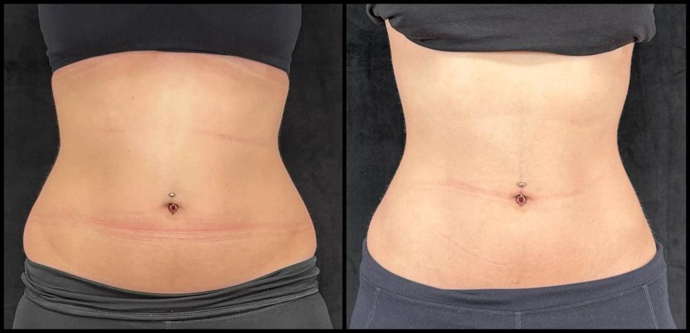 Avant et après CoolSculpting — taille et abdomen, vue de face.