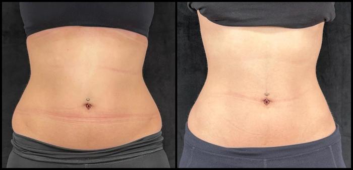 Avant et après CoolSculpting — réduction de la graisse de la taille et de l'abdomen.