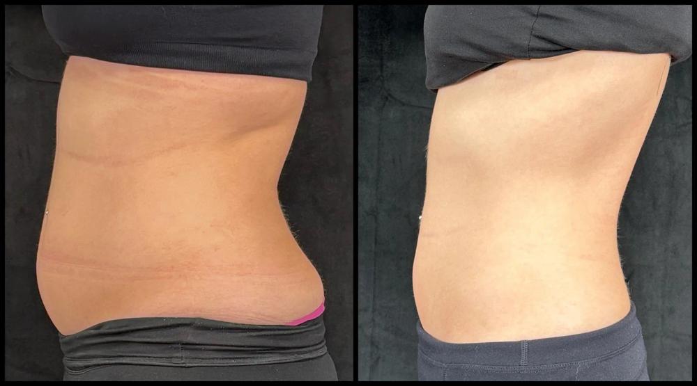 Avant et après CoolSculpting — taille et abdomen, profil gauche.