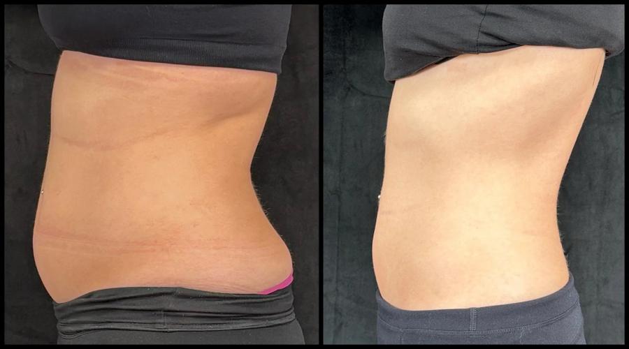 Avant et après CoolSculpting — réduction de la graisse de la taille et de l'abdomen. — Profil gauche