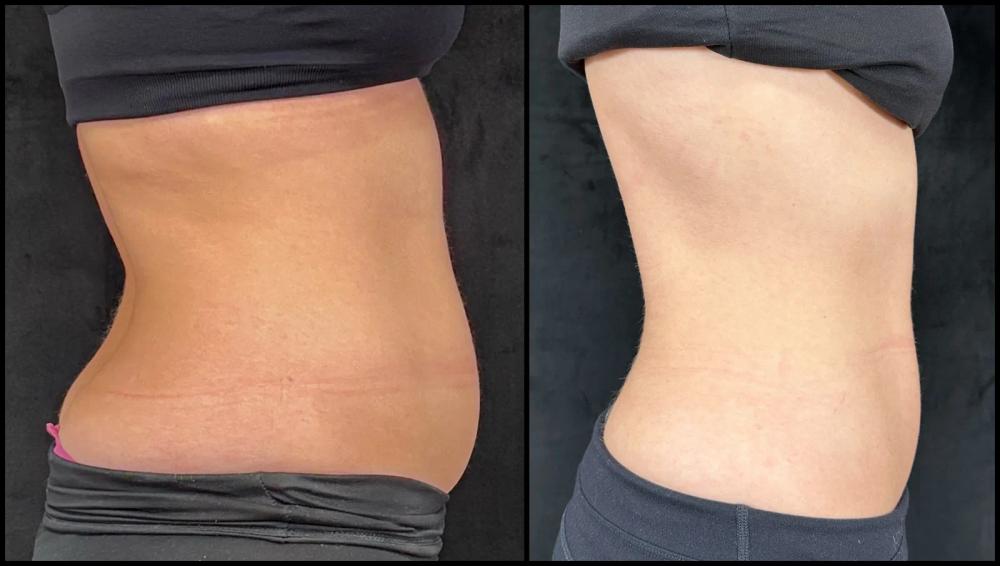 Avant et après CoolSculpting — taille et abdomen, profil droit.