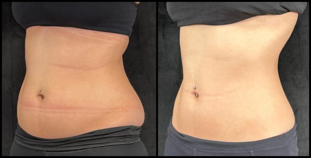 Avant et après CoolSculpting — taille et abdomen, vue oblique.