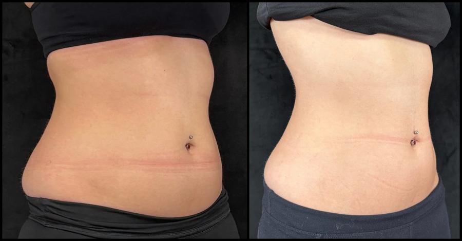 Avant et après CoolSculpting — réduction de la graisse de la taille et de l'abdomen. — Oblique droite