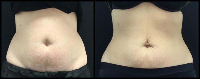 Avant et après CoolSculpting — silhouette abdominale affinée.