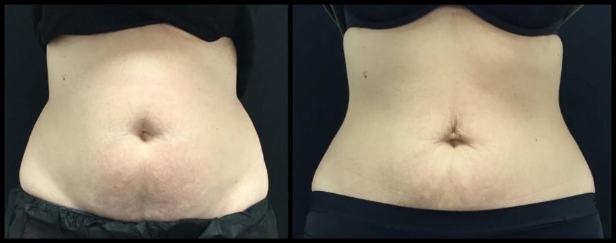 Avant et après CoolSculpting — silhouette abdominale affinée.