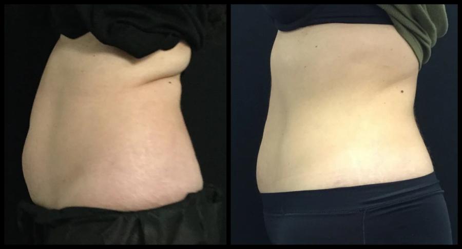 Avant et après CoolSculpting — silhouette abdominale affinée. — Profil