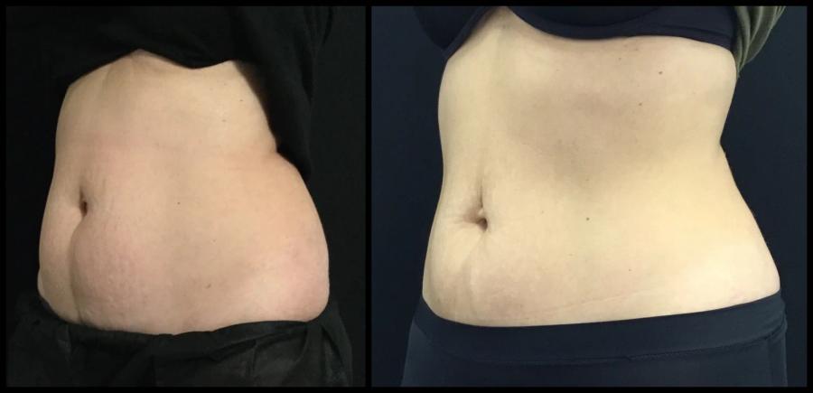 Avant et après CoolSculpting — silhouette abdominale affinée. — Vue oblique