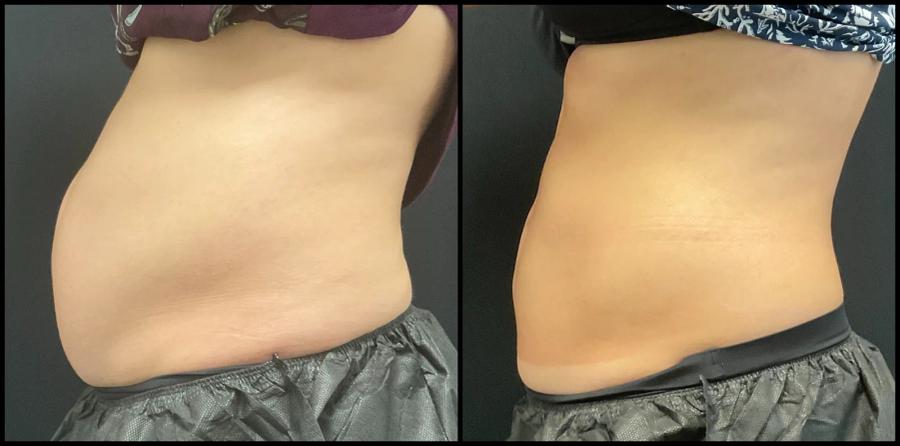 Avant et après CoolSculpting — taille et hanches redessinées. — Profil gauche