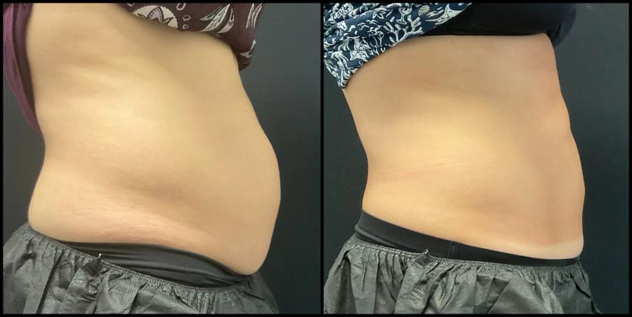 Avant et après CoolSculpting — taille et hanches redessinées. — Profil droit