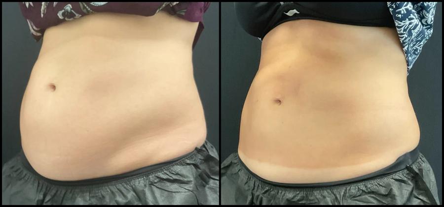 Avant et après CoolSculpting — taille et hanches redessinées. — Oblique gauche
